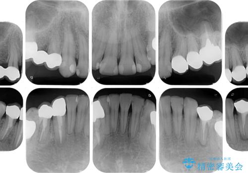 銀歯を白くしたい 一緒に矯正治療も行ない美しい口腔内にの治療後