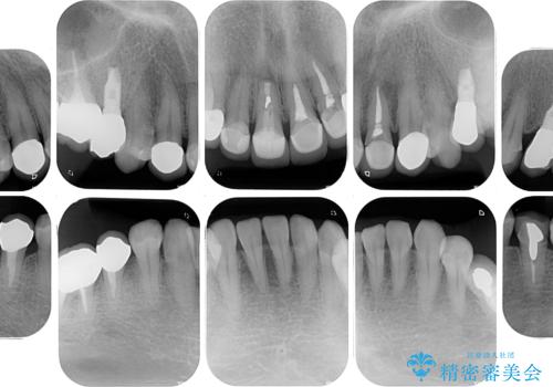 新幹線通院 地元で断られた奥歯のむし歯治療の治療後
