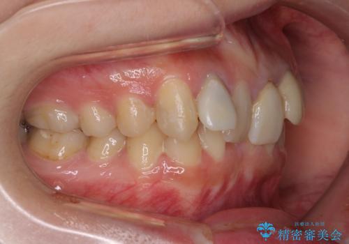 気になっていたむし歯と前歯のデコボコ 矯正治療とむし歯治療の総合歯科治療の治療前