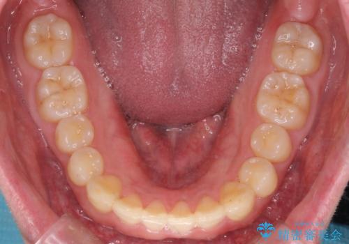 下の歯のがたつきが気になる。 インビザラン&ワイヤー部分矯正併用の治療後