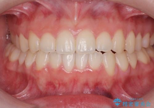 開咬(オープンバイト)の症例 治療後