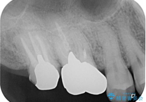 奥歯が取れた フルジルコニアクラウンの治療前