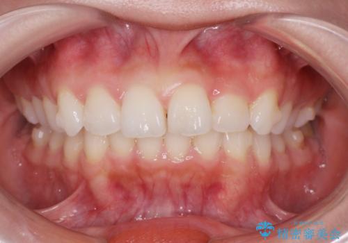 前歯のがたつき気になる。インビザラインモデレートの治療中