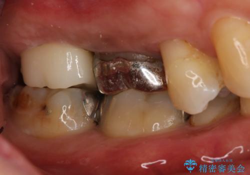 奥歯が取れた フルジルコニアクラウンの治療後