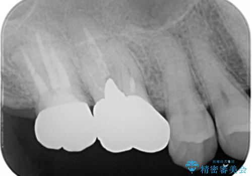 奥歯が取れた フルジルコニアクラウンの治療後