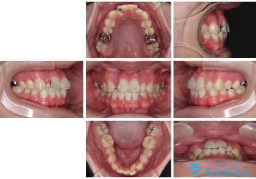 1年でここまで変わる!歯列のがたつきと正中のズレを改善した矯正治療(メタルブラケット×MARPE)の治療前