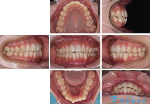 目立たないマウスピース矯正で下の前歯のデコボコをスッキリ解消!たった1年で整った歯並びにの治療前