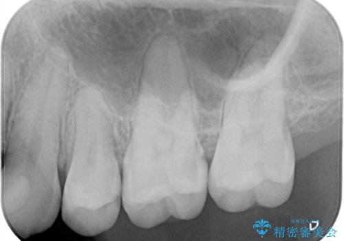 歯と歯の間の虫歯もセラミックで再発防止の症例 治療前