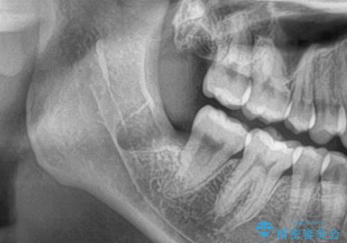 親知らず抜きたい。の治療後