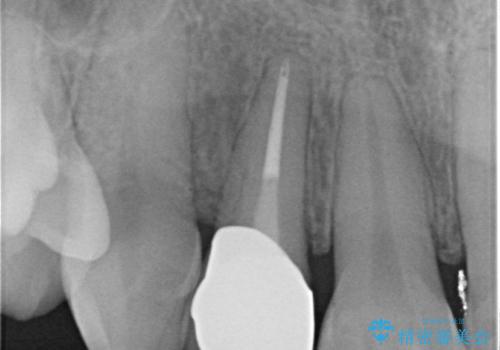 前歯の形と変色が気になる。 ジルコニアクラウンでの修復処置の治療後