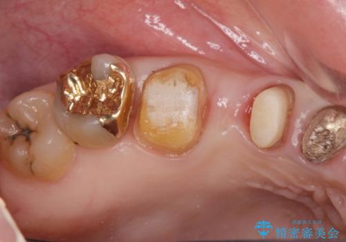 歯周ポケットの除去を併用したセラミック治療の治療中