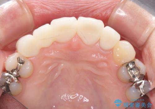 [ 前歯の審美ブリッジ治療]   前歯の見た目をなんとかしたい!の治療後