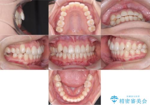 非抜歯矯正で八重歯を改善|短期間8か月で美しい歯並びに|インビザラインライト上顎のみで矯正の治療前
