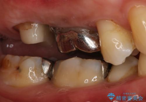 奥歯が取れた フルジルコニアクラウンの治療中