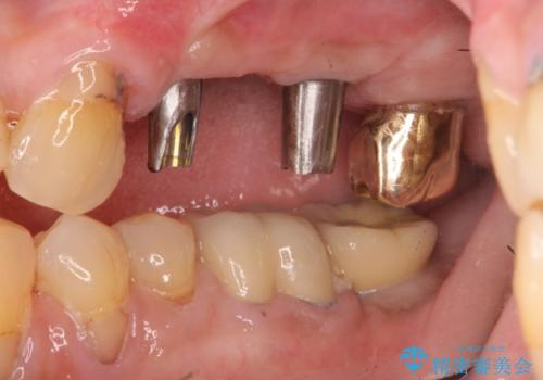 入れ歯では食事を楽しめない。インプラントによる咬合機能回復の治療中