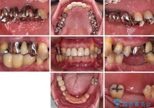 強い咬合力で奥歯がボロボロに インプラント治療による咬合回復と全顎セラミック治療の治療前