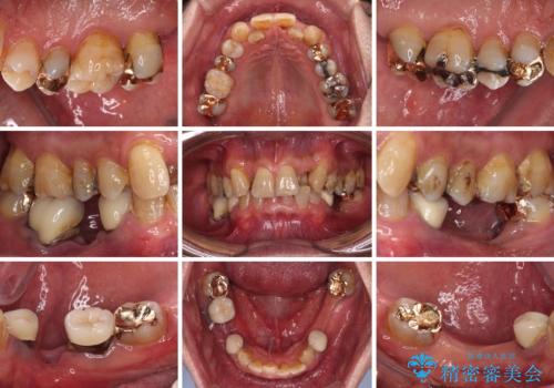 奥歯の欠損と前歯のデコボコを治したい　インプラントと矯正治療の総合歯科治療の治療前