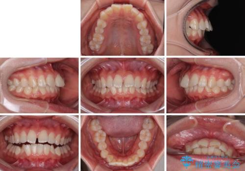 深い咬み合わせによる隙間 インビザライン矯正でコンプレックスを改善の治療前
