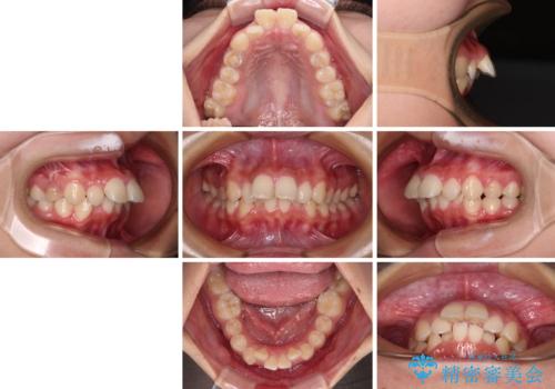 飛び出した口元を改善したい ワイヤー装置による抜歯矯正治療の治療前