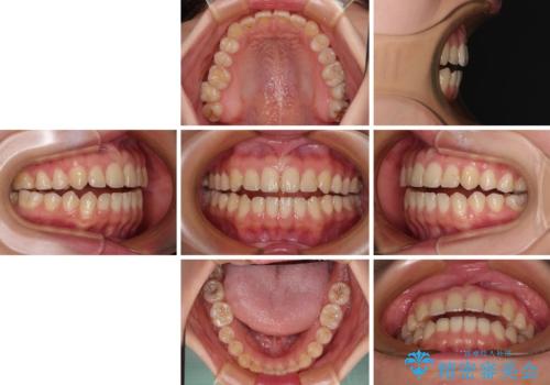 前歯のオープンバイト インビザラインで咬み合わせを改善の治療前