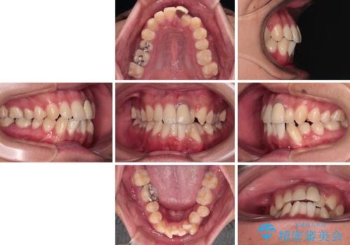 気になる前歯のデコボコと八重歯 ワイヤー矯正ですっきりとの治療前