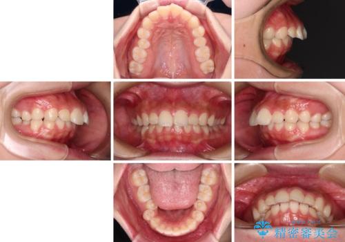 骨格的な出っ歯を抜歯矯正で改善 横顔の印象が劇的に変化の治療前
