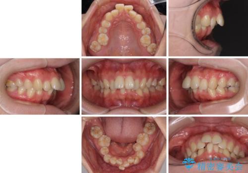 全顎的なデコボコと口元の突出感 ワイヤー装置での抜歯矯正で整った口元にの治療前