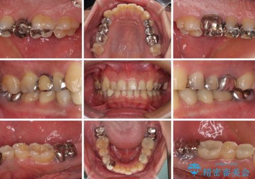 銀歯を白くしたい 一緒に矯正治療も行ない美しい口腔内にの治療前