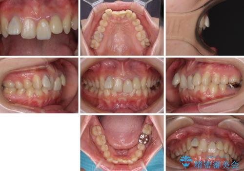 気になっていたむし歯と前歯のデコボコ 矯正治療とむし歯治療の総合歯科治療の治療前