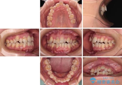 骨格的なズレを歯列矯正でカバー ワイヤー装置での非抜歯矯正の治療前