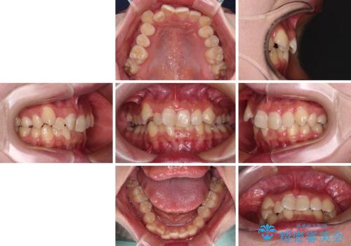 気になる八重歯 ワイヤー装置での抜歯矯正の治療前