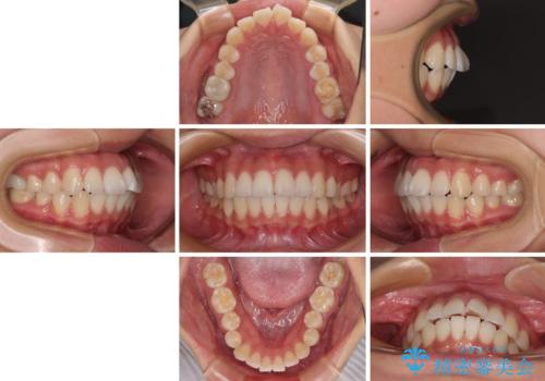 唇を閉じて眠れない ワイヤー装置での抜歯矯正で口元をスッキリとの治療前