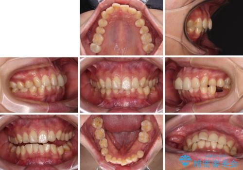 デコボコと乳歯の欠損 ワイヤー矯正とインプラント補綴治療の治療前