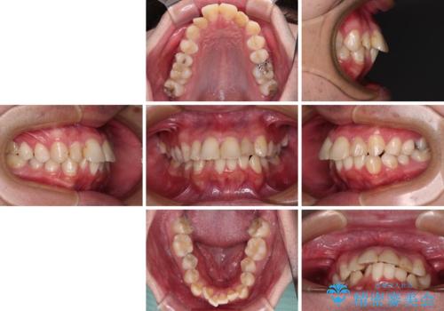 【モニター】出っ歯と奥歯の咬み合わせを改善 補助装置を用いたワイヤー抜歯矯正の治療前