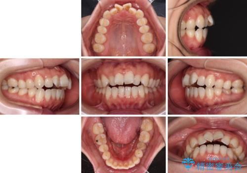 【モニター】飛び出した上顎前歯 補助装置を併用したインビザライン矯正治療の治療前