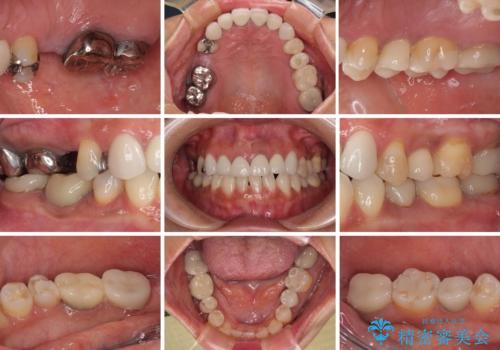 新幹線通院 地元で断られた奥歯のむし歯治療の治療前