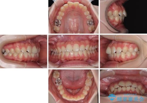 気になる前歯を矯正 短期間のワイヤー矯正治療の治療前
