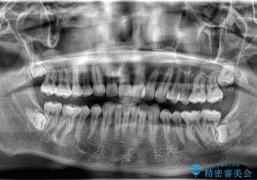 必ずしもワイヤーでなくても大丈夫!インビザラインでデコボコ歯列&過蓋咬合を改善の治療後