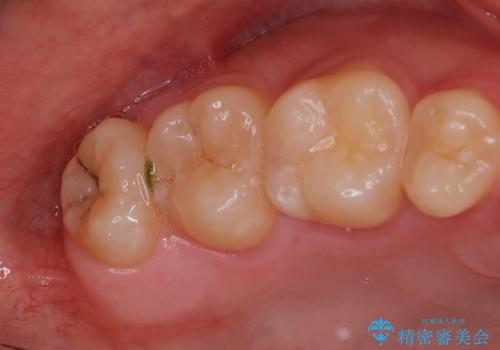 親知らず抜きたい。の治療前