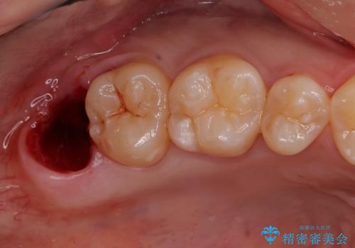 親知らず抜きたい。の治療後