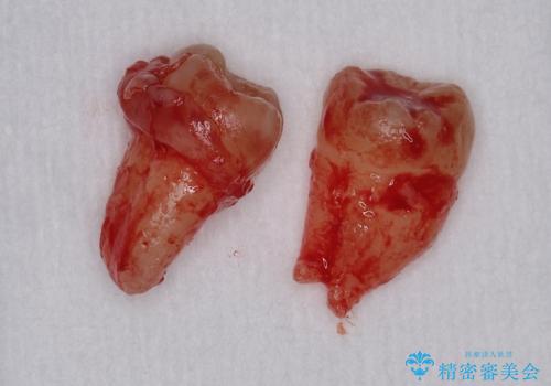 親知らず抜きたい。の治療中