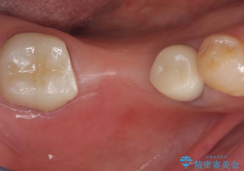 【ゴールドクラウン】セラミックのブリッジが何度も壊れる