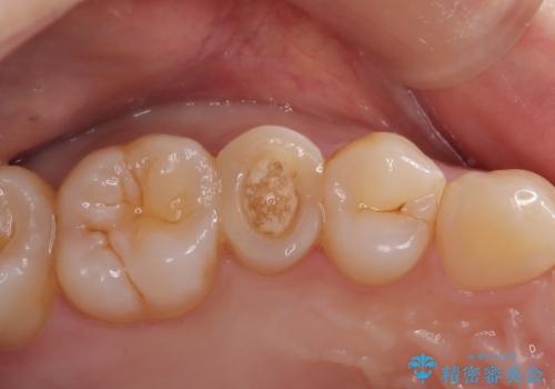 【根管治療】【セラミッククラウン】根っこが細くて治療できないと言われたの症例 治療前