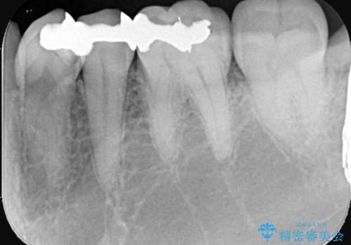 銀歯の下に虫歯 〈オールセラミッククラウン〉の治療前