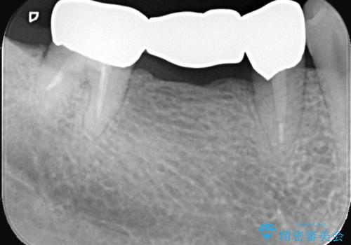 【ゴールドクラウン】セラミックのブリッジが何度も壊れるの治療後