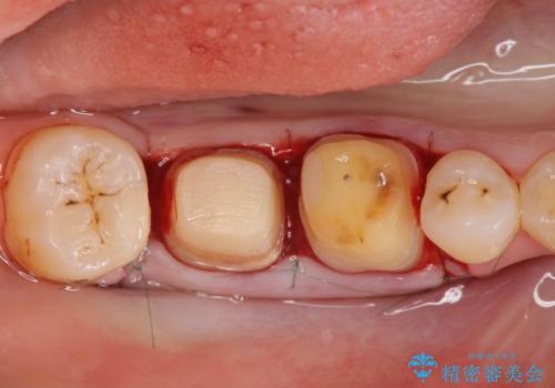 歯周ポケットの除去を併用したセラミック治療の治療中