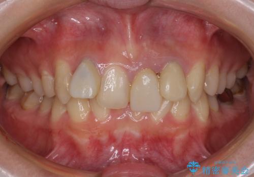 気になっていたむし歯と前歯のデコボコ 矯正治療とむし歯治療の総合歯科治療の症例 治療前