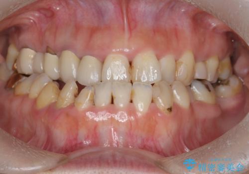 歯周病治療&セラミック治療の症例 治療前