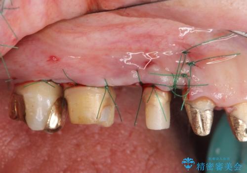 歯周ポケットの除去を併用したセラミック治療の治療中