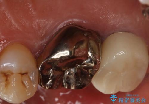 奥歯が取れた フルジルコニアクラウンの治療後